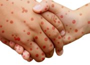 KLB Campak Sumenep Meningkat, Pemprov Jatim Gencarkan ORI Vaksinasi MR.