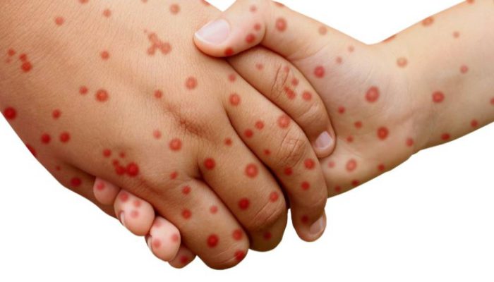 KLB Campak Sumenep Meningkat, Pemprov Jatim Gencarkan ORI Vaksinasi MR.